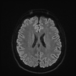 File:Cochlear incomplete partition type III associated with hypothalamic hamartoma (Radiopaedia 88756-105498 Axial DWI 66).jpg