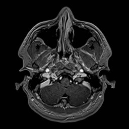 File:Cochlear incomplete partition type III associated with hypothalamic hamartoma (Radiopaedia 88756-105498 Axial T1 C+ 40).jpg