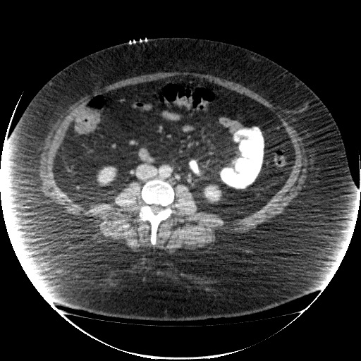 Collection due to leak after sleeve gastrectomy (Radiopaedia 55504-61972 A 45).jpg