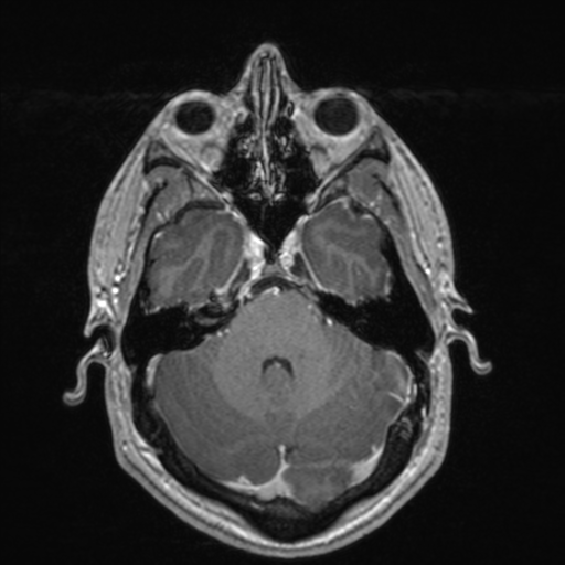 File:Colloid cyst (Radiopaedia 44510-48181 Axial T1 C+ 59).png