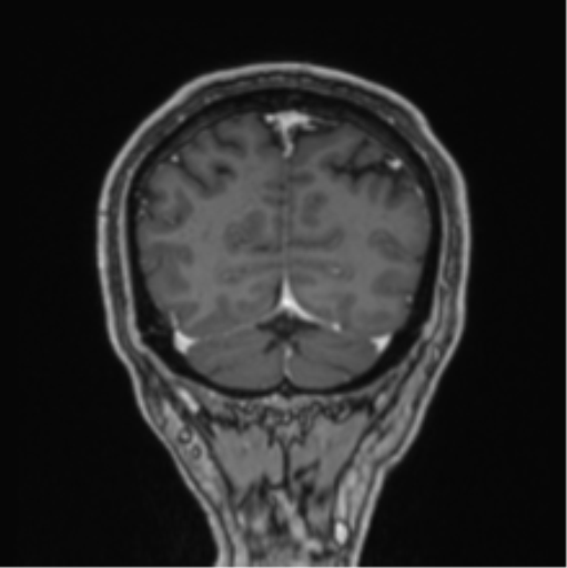File:Colloid cyst of the third ventricle (Radiopaedia 86571-102662 Coronal T1 C+ 19).png
