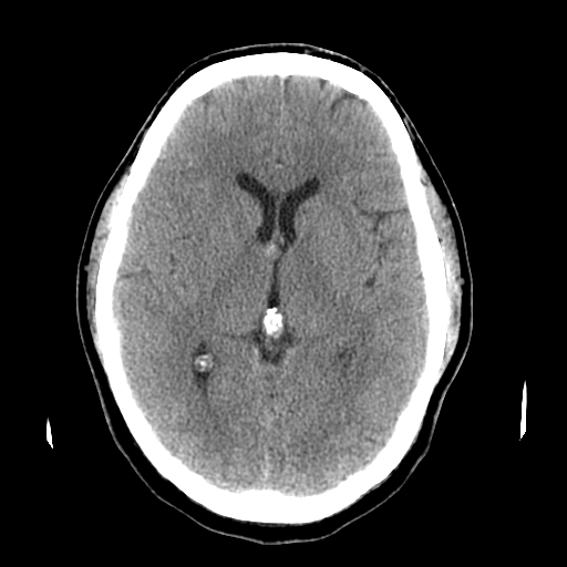 File:Colloid cyst with anterior communicating artery aneurysm (Radiopaedia 33901-35090 Axial non-contrast 12).jpg