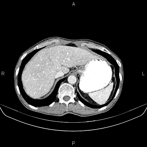 File:Colon adenocarcinoma - hepatic flexure (Radiopaedia 85635-101395 A 17).jpg