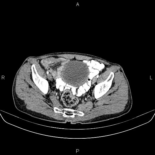 Colon adenocarcinoma - hepatic flexure (Radiopaedia 85635-101395 A 82).jpg