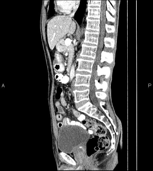 Colon adenocarcinoma - hepatic flexure (Radiopaedia 85635-101395 D 44).jpg