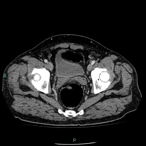 Colon adenocarcinoma with calcific liver metastasis (Radiopaedia 55745-62300 B 42).jpg