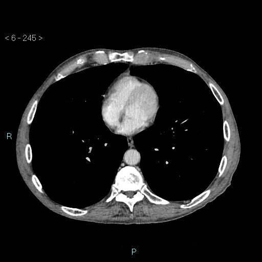File:Colonic cancer (ultrasound and TC imaging) (Radiopaedia 50346-55713 B 245).jpg