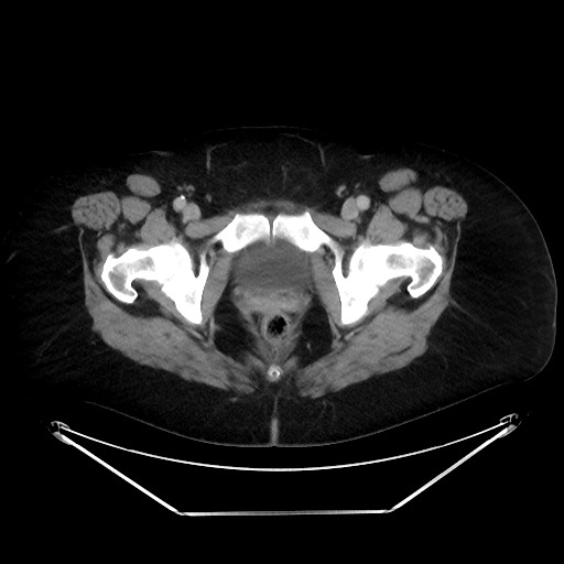 File:Colonic intussusception due to adenocarcinoma (Radiopaedia 86828-102987 A 146).jpg