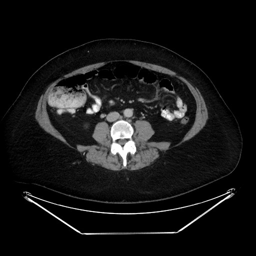 File:Colonic intussusception due to adenocarcinoma (Radiopaedia 86828-102987 A 85).jpg