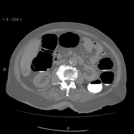 File:Colonic lipomas (Radiopaedia 49137-54244 Axial bone window 92).jpg
