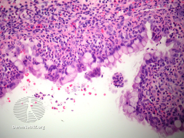 File:Figure 3 (DermNet NZ pathology-e-median-raphe-cyst-figure-3).jpg