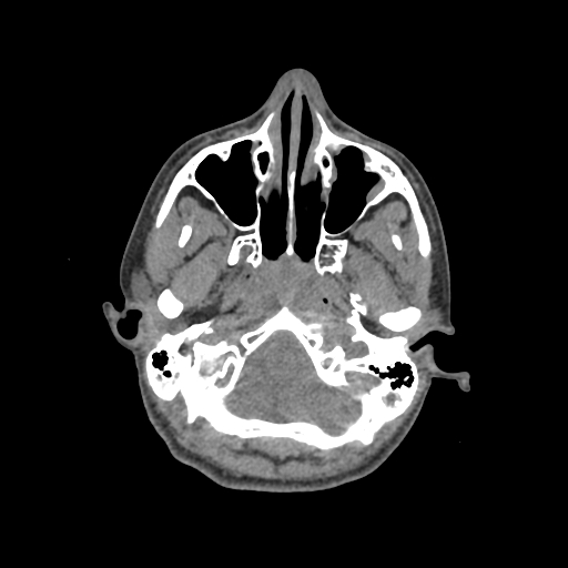 Nasal pyogenic granuloma (lobular capillary hemangioma) (Radiopaedia 85536-101244 Axial non-contrast 55).jpg