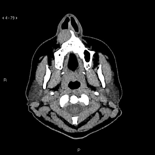 Nasolabial cyst (Radiopaedia 75125-86194 Axial non-contrast 41).jpg