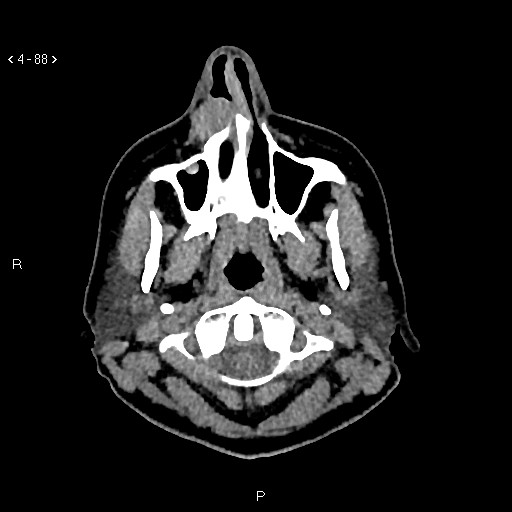 Nasolabial cyst (Radiopaedia 75125-86194 Axial non-contrast 50).jpg