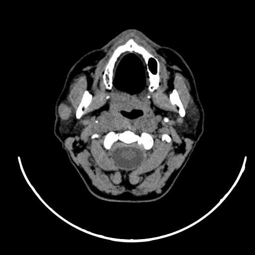 File:Nasopharyngeal carcinoma - infiltrating the clivus (Radiopaedia 62583-70875 Axial non-contrast 24).jpg