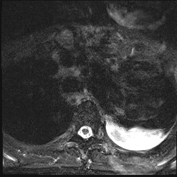 File:Nasopharyngeal carcinoma with skull base invasion (Radiopaedia 59258-66600 Axial T2 fat sat 32).jpg
