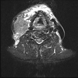 File:Nasopharyngeal carcinoma with skull base invasion (Radiopaedia 59258-66600 Axial T2 fat sat 8).jpg