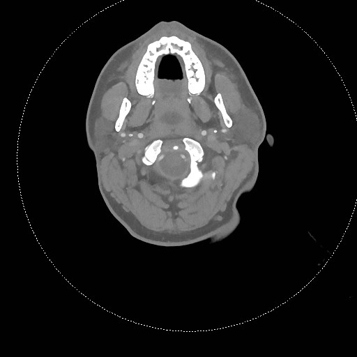 Neck CT angiogram (intraosseous vascular access) (Radiopaedia 55481-61945 B 240).jpg