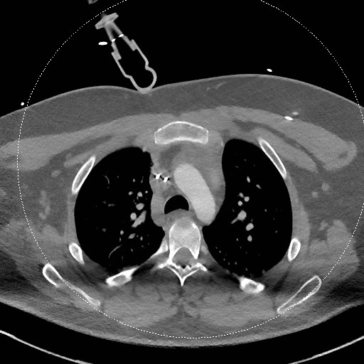 File:Neck CT angiogram (intraosseous vascular access) (Radiopaedia 55481-61945 B 51).jpg