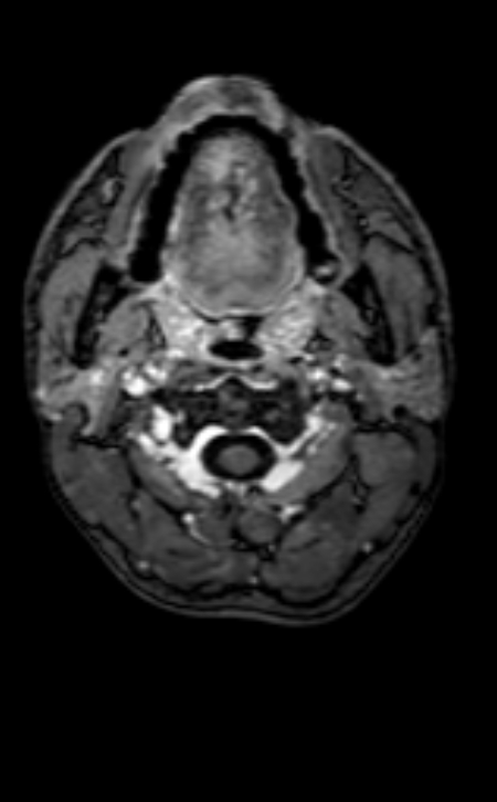 Neuro-Behçet disease (Radiopaedia 90112-107294 Axial T1 C+ 223).jpg