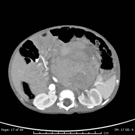 File:Neuroblastoma (Radiopaedia 41472-44355 A 17).jpg