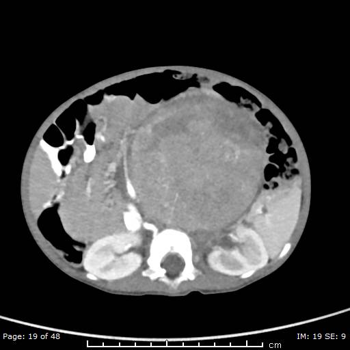 File:Neuroblastoma (Radiopaedia 41472-44355 A 19).jpg