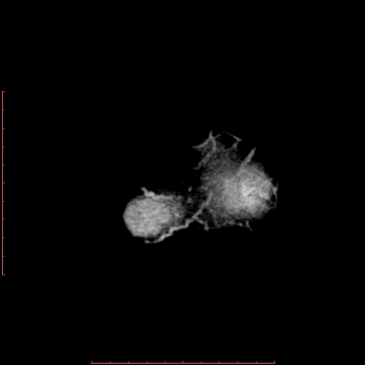 File:Neuroblastoma skull metastasis (Radiopaedia 56053-62683 Axial non-contrast 17).jpg