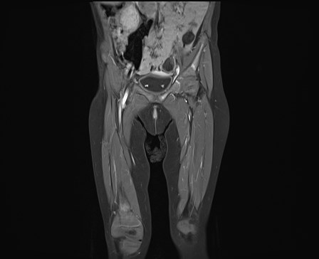 File:Neuroblastoma with bone metastases (Radiopaedia 67080-76414 E 8).jpg
