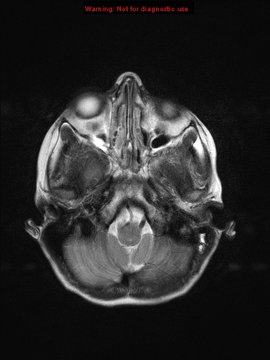 File:Neurofibromatosis type 1 with optic nerve glioma (Radiopaedia 16288-15965 Axial T2 21).jpg
