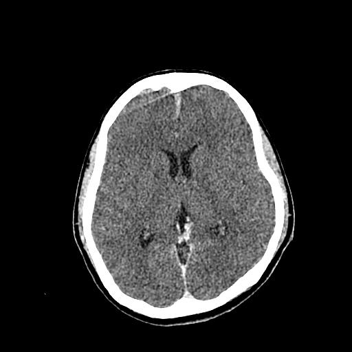 File:Neurofibromatosis type 2 (Radiopaedia 25389-25637 Axial C+ 49).jpg