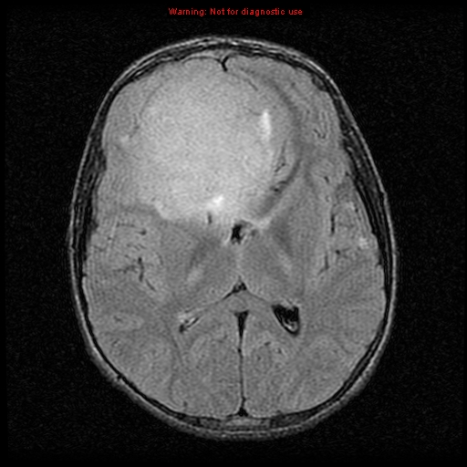 File:Neurofibromatosis type 2 (Radiopaedia 8953-9730 Axial FLAIR 14).jpg