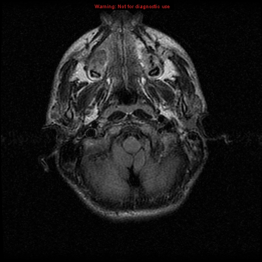 File:Neurofibromatosis type 2 (Radiopaedia 8953-9730 Axial FLAIR 5).jpg