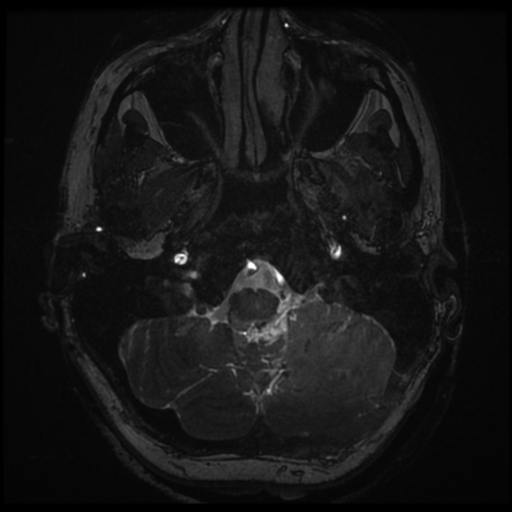 Neurofibromatosis type 2 - bilateral acoustic neuromata (Radiopaedia 40060-42566 Axial FIESTA 10).png