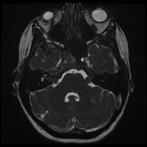 Neurofibromatosis type 2 - bilateral acoustic neuromata (Radiopaedia 40060-42566 Axial FIESTA 41).png