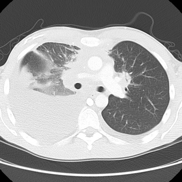 File:Non-Hodgkin lymphoma involving lung (Radiopaedia 29094-29470 Axial lung window 30).jpg
