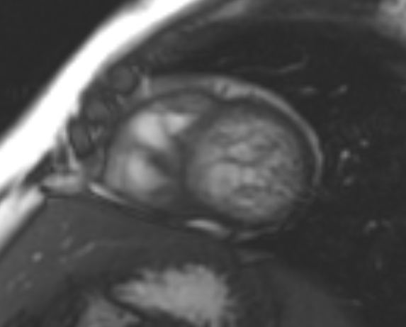 File:Non-compaction of the left ventricle (Radiopaedia 69436-79314 Short axis cine 91).jpg