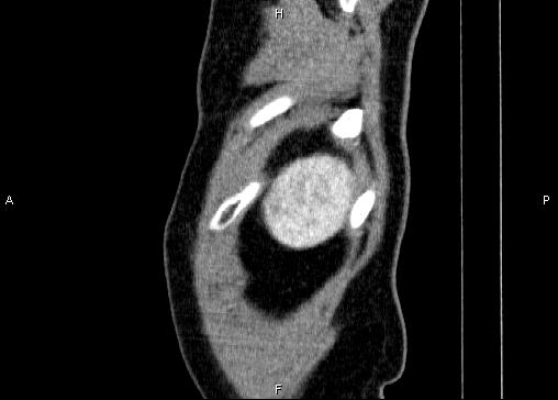 Non-syndromic pancreatic endocrine tumor (Radiopaedia 86958-103178 E 100).jpg