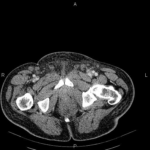 File:Non Hodgkin lymphoma in a patient with ankylosing spondylitis (Radiopaedia 84323-99621 B 66).jpg
