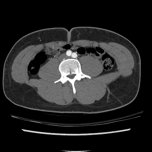 File:Normal CT angiogram of pelvis (Radiopaedia 45390-49430 A 14).jpg