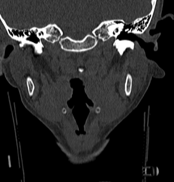 File:Normal CT cervical spine - 12-year-old (Radiopaedia 55352-61775 Coronal bone window 15).jpg