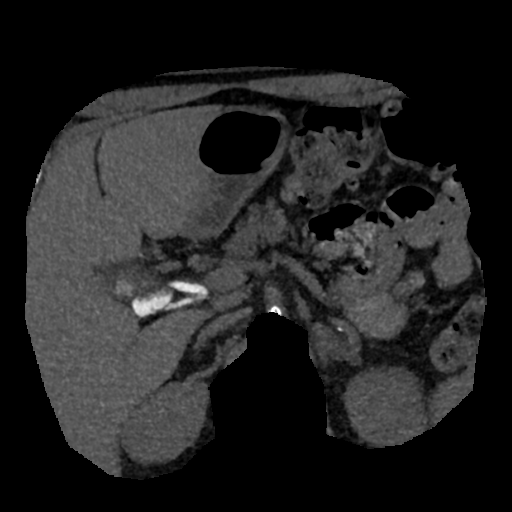 File:Normal CT intravenous cholangiogram (Radiopaedia 38199-40208 Axial IVC (MIP) 45).png