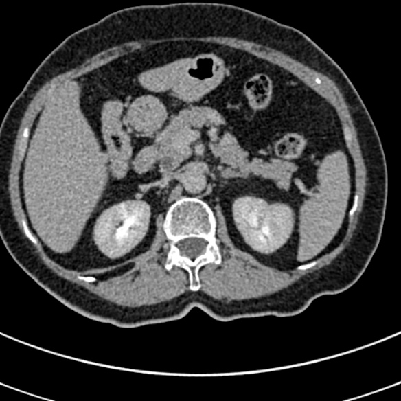 File:Normal CT split bolus study of the renal tract (Radiopaedia 48631-53634 Axial split bolus 45).jpg