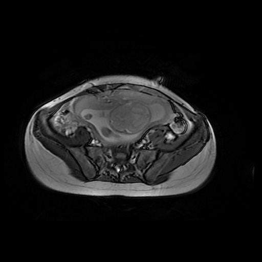 File:Normal MRI abdomen in pregnancy (Radiopaedia 88001-104541 Axial Gradient Echo 40).jpg