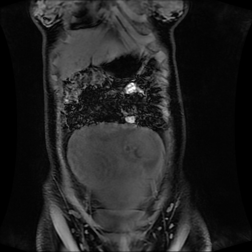 Normal MRI abdomen in pregnancy (Radiopaedia 88001-104541 M 39).jpg