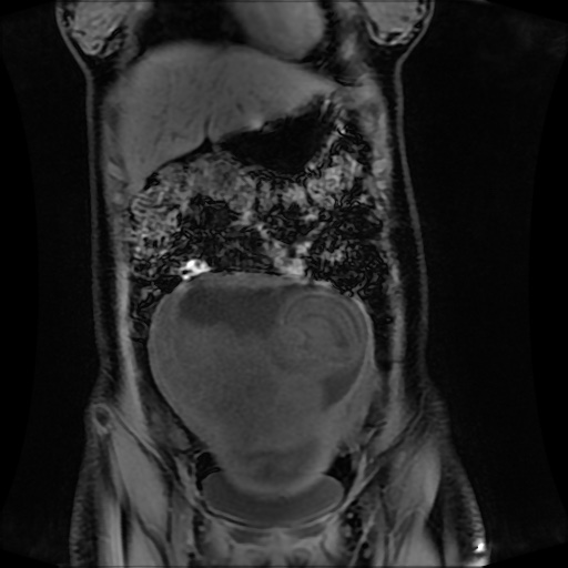 Normal MRI abdomen in pregnancy (Radiopaedia 88001-104541 M 44).jpg