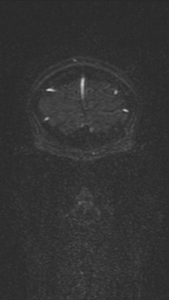 Normal MRI brain with MRV- teenager (Radiopaedia 49425-54553 Coronal MRV 42).jpg
