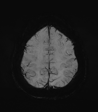 Normal MRI internal auditory canal (Radiopaedia 41613-44525 Axial SWI MIP 65).png