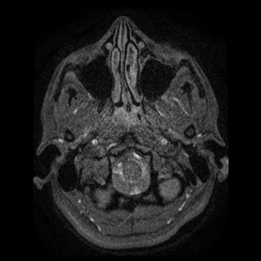 Normal brain MRA (Radiopaedia 41046-43793 Axial MRA 118).png