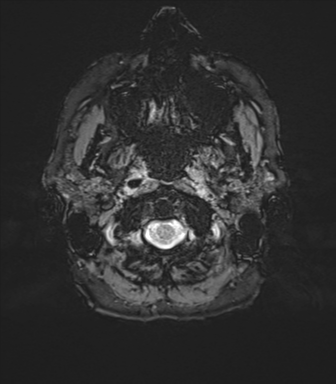 Normal brain MRI (TLE protocol) (Radiopaedia 40748-43405 Axial SWI 1).png