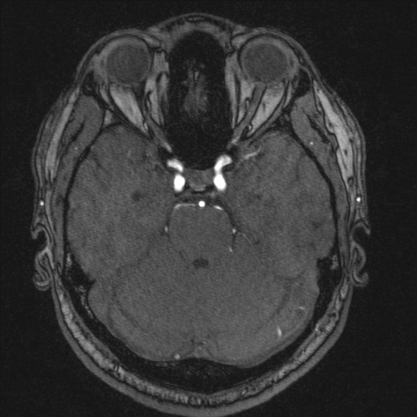 Normal brain MRI including MRA (Radiopaedia 48748-53763 Axial MRA 67).jpg